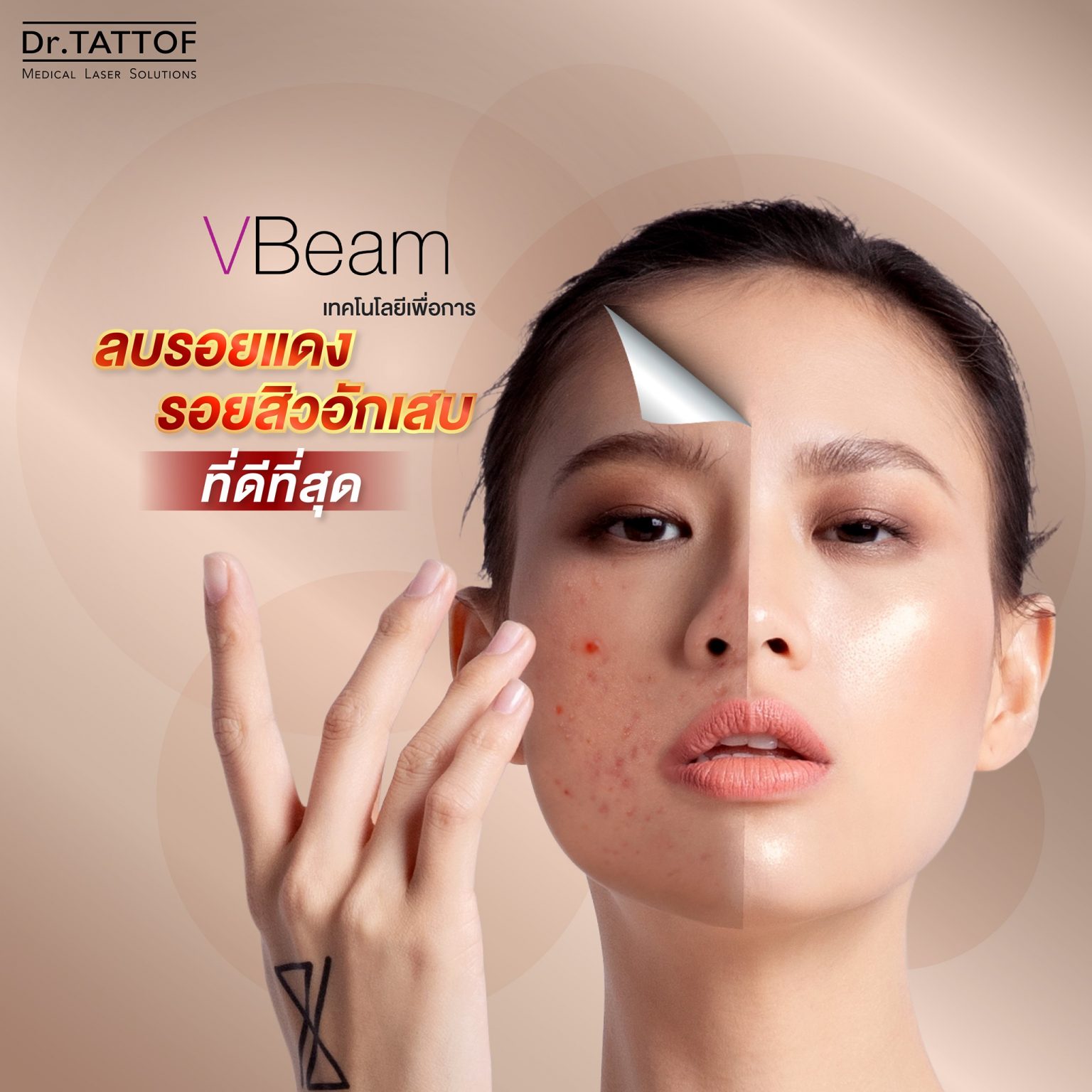 Vbeam Laser ลบรอยแดงสิวอักเสบที่ดีที่สุด Dr.TATTOF
