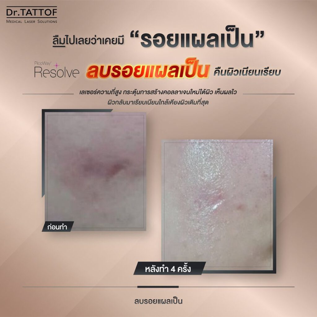 เลเซอร์แผลเป็นที่หน้า ราคา