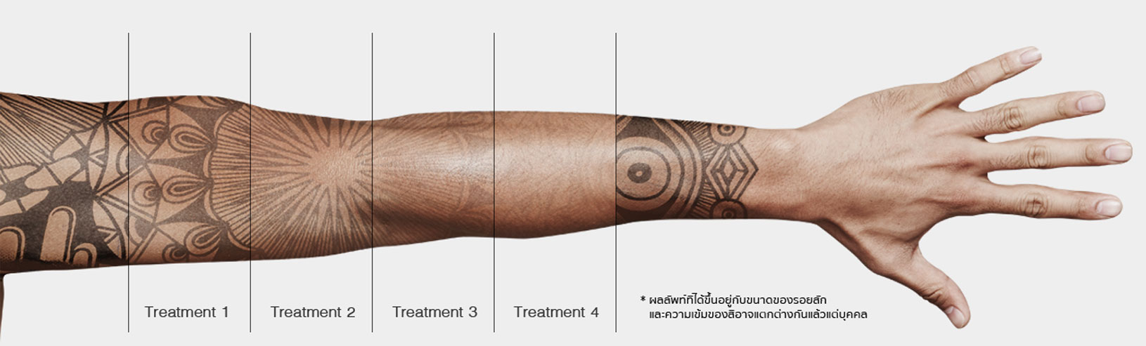 laser away tattoo removal costTikTok Search