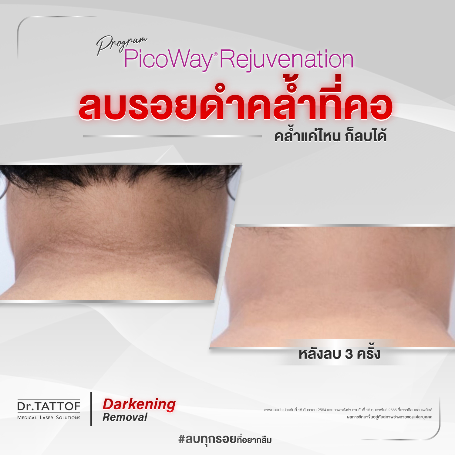 ลบรอยดำคล้ำ