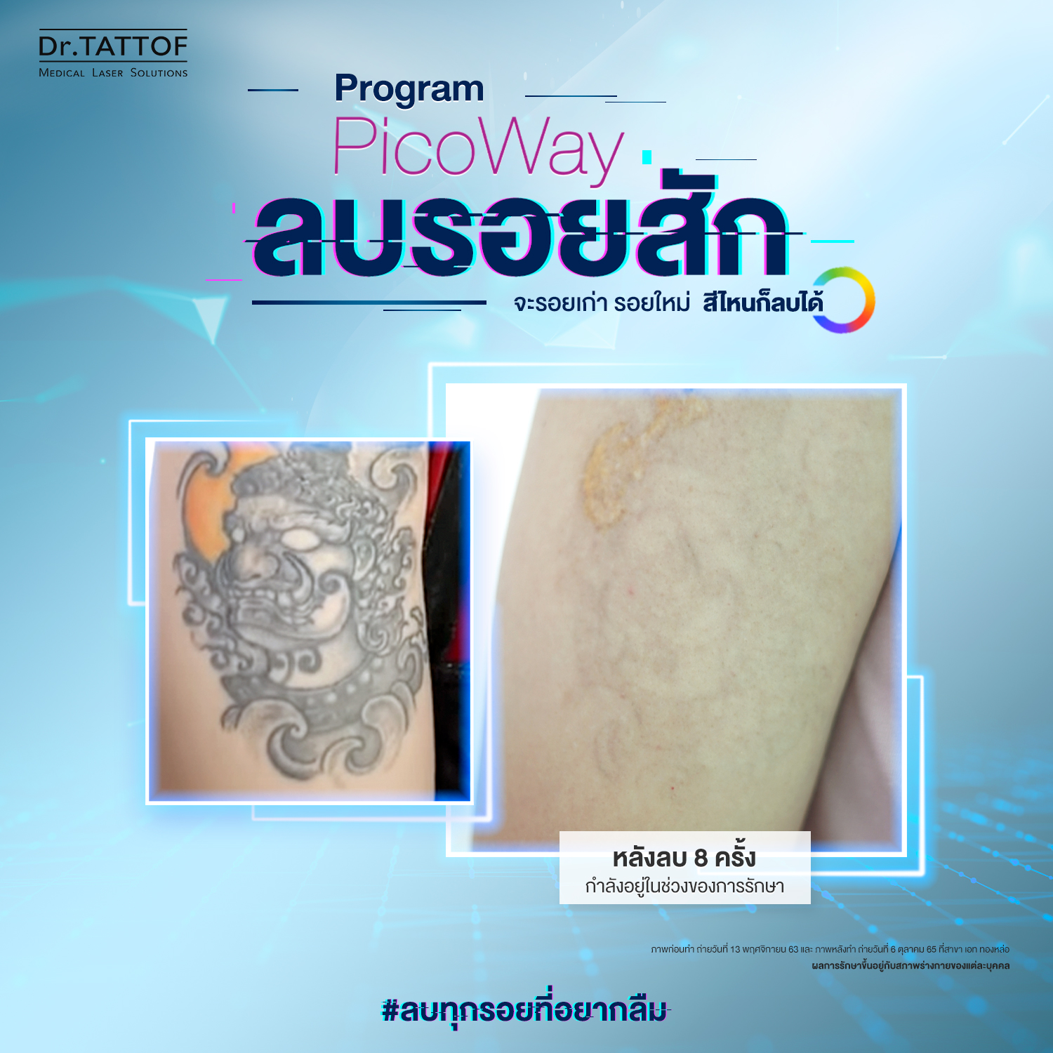 ลบรอยสัก