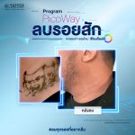 ลบรอยสัก