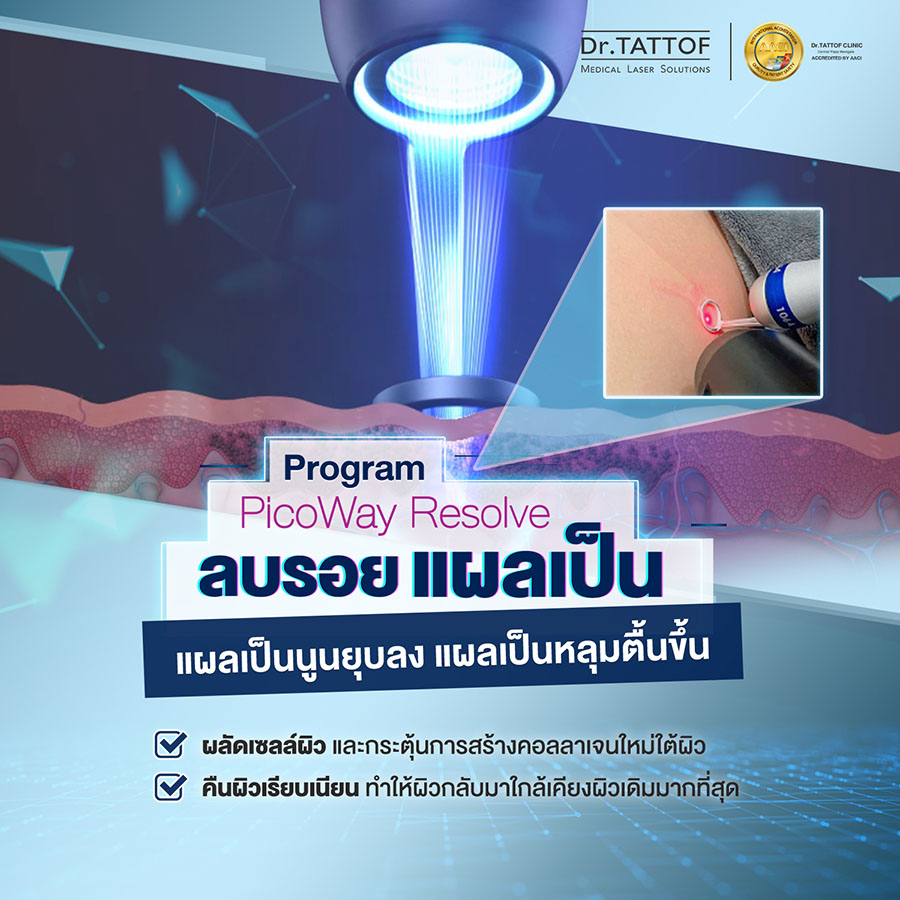 เลเซอร์ลบรอยแผลเป็น โปรแกรม PicoWay Resolve Laser